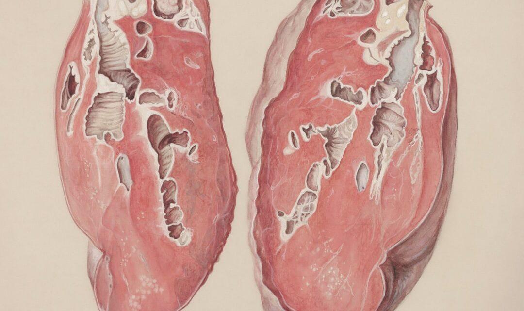 découvrez le syndrome de houdini : ses causes, ses symptômes et les traitements possibles. informez-vous sur ce phénomène rare touchant le système digestif.