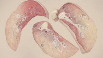 découvrez les symptômes, causes et traitements de la gastrite nerveuse, une inflammation de l'estomac liée au stress et à l'anxiété.